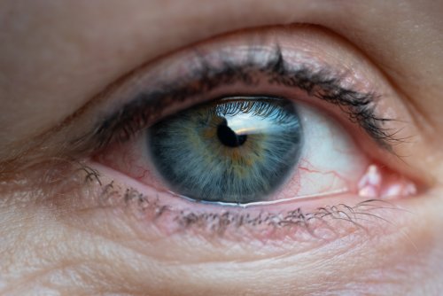 girl-with-irritated-dry-red-eye-or-allergy-female-2021-09-03-20-06-05-utc.jpg