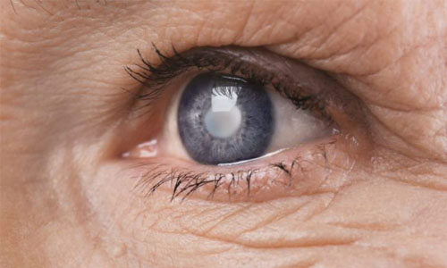 _0001_glaucoma.jpg